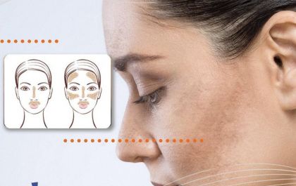 Dermatologista Dra. Maria Angélica Gorga responde: Como tratar o melasma? Confira!