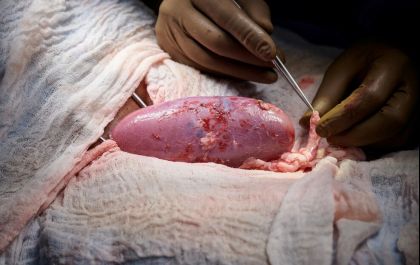 Greys Anatomy da vida real; brasileiros estudam transplante de rim suíno em humanos