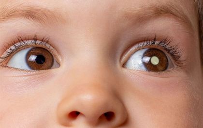 Conheça mais sobre o retinoblastoma e saiba como identificá-lo