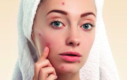 Acne: muito além da estética