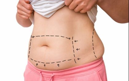 Quem pode fazer a cirurgia Bariátrica?